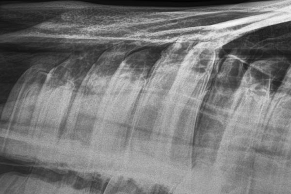 XrayMaxilla